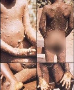 Mexico confirms first imported case of monkeypox | Mexico confirms first imported case of monkeypox