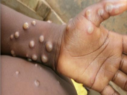 UK health security agency detects 71 new cases of Monkeypox | UK health security agency detects 71 new cases of Monkeypox