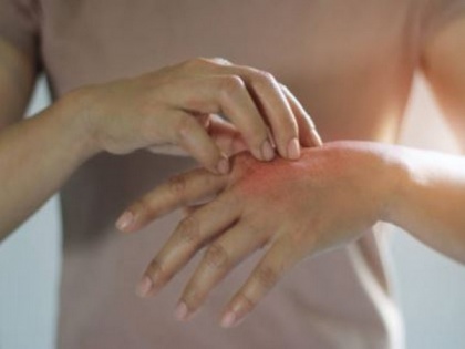 Light therapy helps burn injuries heal faster, study finds | Light therapy helps burn injuries heal faster, study finds