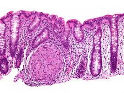 Study reveals important genetic mechanism behind inflammatory bowel disease | Study reveals important genetic mechanism behind inflammatory bowel disease