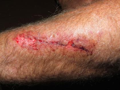 Researchers develop printing technique for effective skin equivalent to heal wounds | Researchers develop printing technique for effective skin equivalent to heal wounds