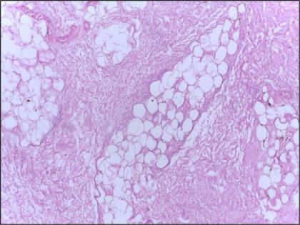 Researchers find aggressive 'hot spots' inside breast cancer tumours | Researchers find aggressive 'hot spots' inside breast cancer tumours
