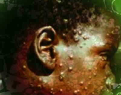 WHO declares global health emergency over Mpox outbreak | WHO declares global health emergency over Mpox outbreak WHO declares global health emergency over Mpox outbreak | WHO declares global health emergency over Mpox outbreak