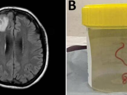 8-cm live worm removed from woman's brain in world's 1st discovery | 8-cm live worm removed from woman's brain in world's 1st discovery 8-cm live worm removed from woman's brain in world's 1st discovery | 8-cm live worm removed from woman's brain in world's 1st discovery