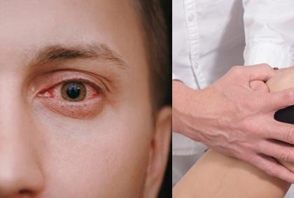 After pink eye, Delhi doctors report 50% rise in joints pain & arthritis | After pink eye, Delhi doctors report 50% rise in joints pain & arthritis After pink eye, Delhi doctors report 50% rise in joints pain & arthritis | After pink eye, Delhi doctors report 50% rise in joints pain & arthritis