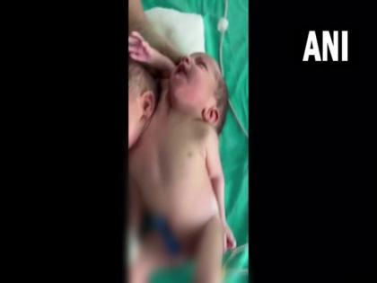 Woman in MP's Ratlam gives birth to child with two heads, three arms | Woman in MP's Ratlam gives birth to child with two heads, three arms