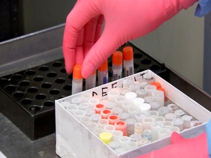 One more tests positive for COVID-19 in Uttarakhand, total count rises to 51 | One more tests positive for COVID-19 in Uttarakhand, total count rises to 51 One more tests positive for COVID-19 in Uttarakhand, total count rises to 51 | One more tests positive for COVID-19 in Uttarakhand, total count rises to 51