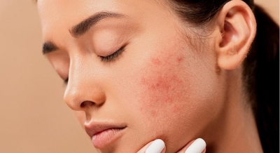 Home remedies to fight hormonal acne | Home remedies to fight hormonal acne