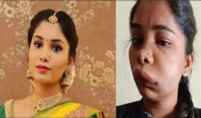 Kannada actress Swathi's face swollen after root canal surgery | Kannada actress Swathi's face swollen after root canal surgery