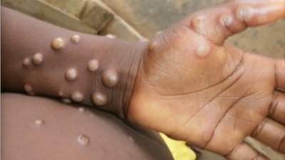 Global cases of monkeypox surpass 1,000: US CDC | Global cases of monkeypox surpass 1,000: US CDC