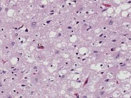 Researchers find new potential treatment for prion diseases | Researchers find new potential treatment for prion diseases