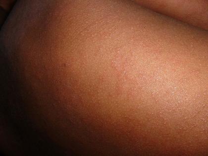 New Zealand issues alert following confirmed case of measles | New Zealand issues alert following confirmed case of measles New Zealand issues alert following confirmed case of measles | New Zealand issues alert following confirmed case of measles