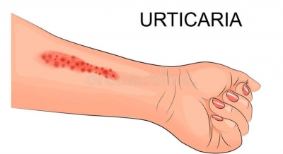 Urticaria: Managing a skin disorder that needs urgent medical care | Urticaria: Managing a skin disorder that needs urgent medical care