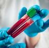 SGPGIMS to provide free DNA testing for hepatitis | SGPGIMS to provide free DNA testing for hepatitis SGPGIMS to provide free DNA testing for hepatitis | SGPGIMS to provide free DNA testing for hepatitis