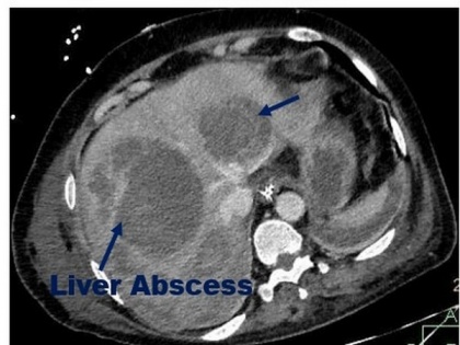 Unusual large, multiple liver abscesses found in patients recovered from COVID-19 | Unusual large, multiple liver abscesses found in patients recovered from COVID-19