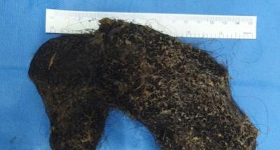 Doctors at Hyderabad hospital remove hairball from Omani girl | Doctors at Hyderabad hospital remove hairball from Omani girl