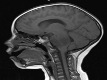 Common brain malformation traced to its genetic roots: Study | Common brain malformation traced to its genetic roots: Study Common brain malformation traced to its genetic roots: Study | Common brain malformation traced to its genetic roots: Study