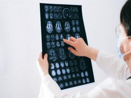 Study finds distant brain regions are wired by few connections | Study finds distant brain regions are wired by few connections Study finds distant brain regions are wired by few connections | Study finds distant brain regions are wired by few connections