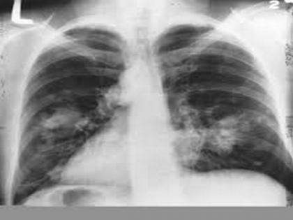 Benefit of low-dose CT for lung cancer screening outweighs potential harm | Benefit of low-dose CT for lung cancer screening outweighs potential harm Benefit of low-dose CT for lung cancer screening outweighs potential harm | Benefit of low-dose CT for lung cancer screening outweighs potential harm