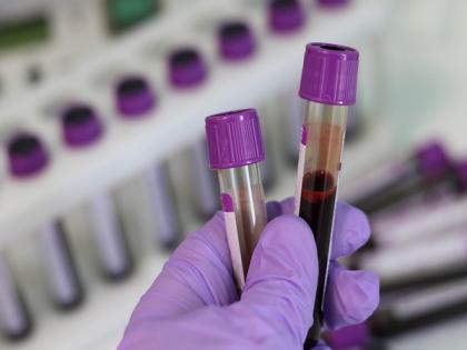 ALS may now be diagnosed with simple, reliable blood tests: Study | ALS may now be diagnosed with simple, reliable blood tests: Study