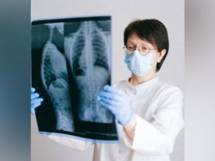 Study finds how persistent lung disease develops long after the virus has been cleared | Study finds how persistent lung disease develops long after the virus has been cleared Study finds how persistent lung disease develops long after the virus has been cleared | Study finds how persistent lung disease develops long after the virus has been cleared