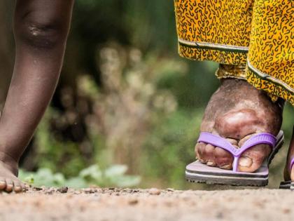 India committed to eliminating lymphatic filariasis by 2027: Mandaviya | India committed to eliminating lymphatic filariasis by 2027: Mandaviya India committed to eliminating lymphatic filariasis by 2027: Mandaviya | India committed to eliminating lymphatic filariasis by 2027: Mandaviya