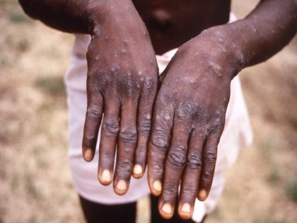 Africa CDC warns spike in monkeypox cases | Africa CDC warns spike in monkeypox cases