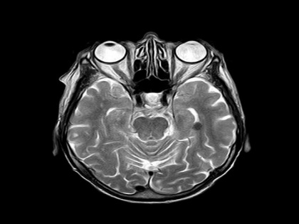 Research on American footballers finds brain lesions in MRI | Research on American footballers finds brain lesions in MRI