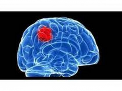 Researchers discover new way to starve brain tumours | Researchers discover new way to starve brain tumours