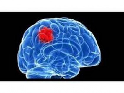 Study finds how to protect molecular guardians of brain from Parkinson's disease | Study finds how to protect molecular guardians of brain from Parkinson's disease