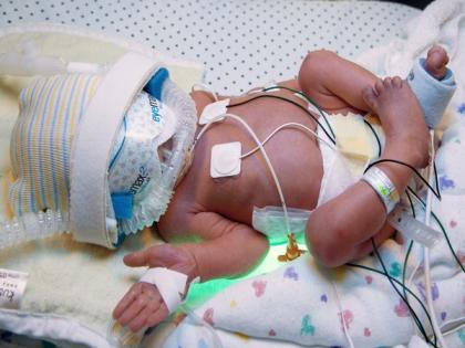 Newborns admitted to NICUs vulnerable to mental disorders in future: Study | Newborns admitted to NICUs vulnerable to mental disorders in future: Study