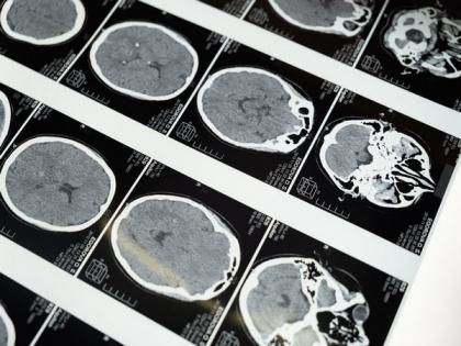 Researchers find new approach for treatment of devastating brain tumours | Researchers find new approach for treatment of devastating brain tumours