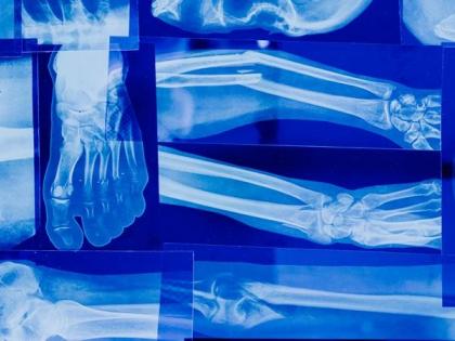 Exposure to PFAS may affect bone health in adolescents & young adults | Exposure to PFAS may affect bone health in adolescents & young adults