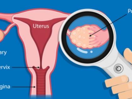 Study shows keto diet boosts fertility among women with PCOS | Study shows keto diet boosts fertility among women with PCOS