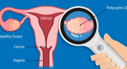 New AI-based test to detect ovarian cancer early with 93% accuracy | New AI-based test to detect ovarian cancer early with 93% accuracy New AI-based test to detect ovarian cancer early with 93% accuracy | New AI-based test to detect ovarian cancer early with 93% accuracy