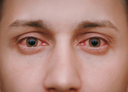 Surge in Hepatitis A and E, eye flu cases following unusual rains in NCR | Surge in Hepatitis A and E, eye flu cases following unusual rains in NCR Surge in Hepatitis A and E, eye flu cases following unusual rains in NCR | Surge in Hepatitis A and E, eye flu cases following unusual rains in NCR