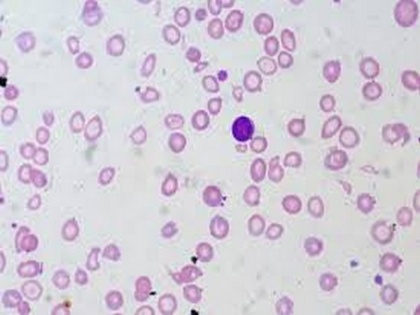 Study reveals improved treatment for children with sickle cell anemia | Study reveals improved treatment for children with sickle cell anemia