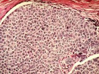 Scientists discover aggressive 'hot spots' inside breast cancer tumours | Scientists discover aggressive 'hot spots' inside breast cancer tumours