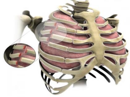 Doctors come up with new surgical procedure to fix broken ribs faster | Doctors come up with new surgical procedure to fix broken ribs faster