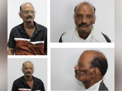 Specialized Silicone Prosthesis Procedure at SRM Kattankulathur Dental College Helps Quick Restoration of Patients with Facial Defect | Specialized Silicone Prosthesis Procedure at SRM Kattankulathur Dental College Helps Quick Restoration of Patients with Facial Defect