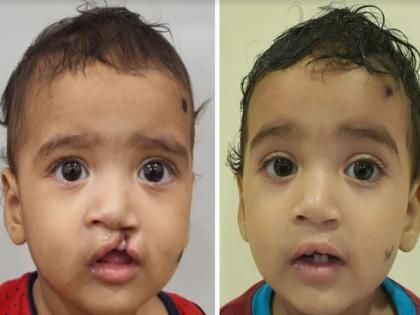 Saveetha join hands with Smile Train for cleft care | Saveetha join hands with Smile Train for cleft care