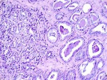 Study reveals adding MRI-targeted biopsy leads to more reliable diagnosis of aggressive prostate cancer | Study reveals adding MRI-targeted biopsy leads to more reliable diagnosis of aggressive prostate cancer Study reveals adding MRI-targeted biopsy leads to more reliable diagnosis of aggressive prostate cancer | Study reveals adding MRI-targeted biopsy leads to more reliable diagnosis of aggressive prostate cancer