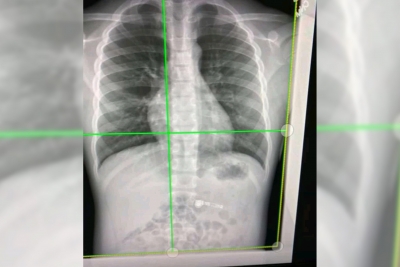 Los rayos X de alta energía muestran vasos pulmonares alterados por Covid-19