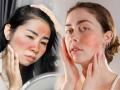 Does Your Skin Turn Red Easily? It Could Be a Sign of Deficiency or Hormonal Imbalance - Hindi News | Does Your Skin Turn Red Easily? It Could Be a Sign of Deficiency or Hormonal Imbalance | Latest health News at Lokmattimes.com