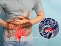Global Increase in Colon Cancer Among Youths: Know What Are Its Symptoms and Key Causes - Hindi News | Global Increase in Colon Cancer Among Youths: Know What Are Its Symptoms and Key Causes | Latest health News at Lokmattimes.com