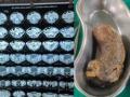 Mumbai: Doctors remove 100gm hairball from minor girl's stomach - Hindi News | Mumbai: Doctors remove 100gm hairball from minor girl's stomach | Latest maharashtra News at Lokmattimes.com