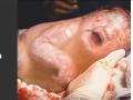 Kashmir sees the first ever reported case of 'En caul' birth - Hindi News | Kashmir sees the first ever reported case of 'En caul' birth | Latest health News at Lokmattimes.com