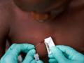 Around 100 cases of Monkeypox virus reported in Europe, which may accelerate warns WHO - Hindi News | Around 100 cases of Monkeypox virus reported in Europe, which may accelerate warns WHO | Latest health News at Lokmattimes.com