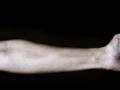 Shocking! 17-year old Bengaluru boy loses arm at friends birthday party - Hindi News | Shocking! 17-year old Bengaluru boy loses arm at friends birthday party | Latest national News at Lokmattimes.com