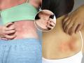 Heat Rash Making Life Uncomfortable? Try These Simple Cooling Remedies - Hindi News | Heat Rash Making Life Uncomfortable? Try These Simple Cooling Remedies | Latest lifestyle News at Lokmattimes.com